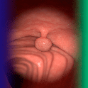 Pólipos do cólon: visão geral do distúrbio digestivo