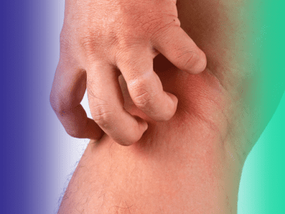 Celulite e erisipela: como diferenciar e por que isso importa no tratamento?