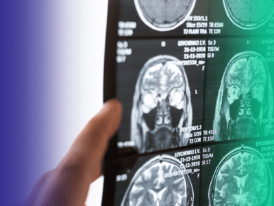 Hematoma subdural: quando suspeitar e como diagnosticar?