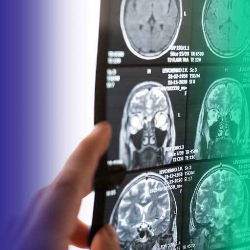 Hematoma subdural: quando suspeitar e como diagnosticar?