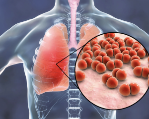 Pneumonia adquirida na comunidade: o que realmente importa no tratamento ambulatorial
