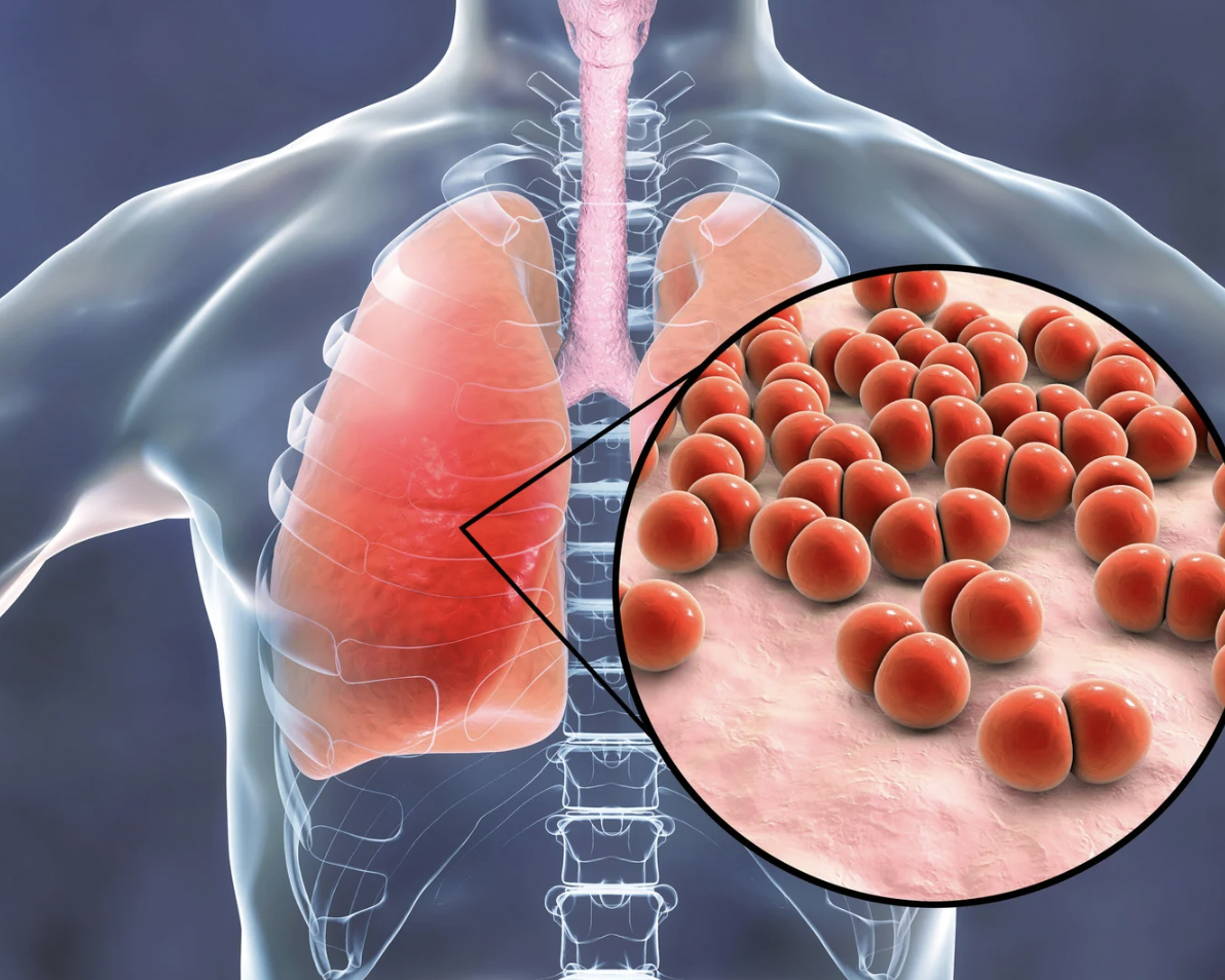 Pneumonia adquirida na comunidade: o que realmente importa no tratamento ambulatorial