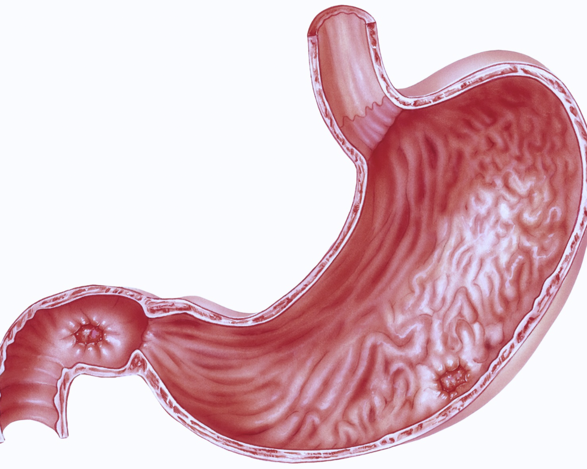 Será o fim dos tratamentos ineficazes de H. pylori?