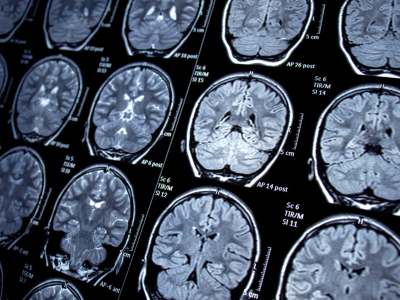 Distúrbios do movimento funcionais: especial NeuroUSP