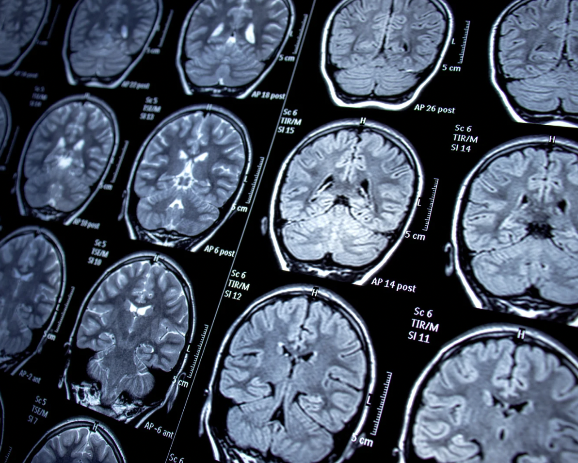 Distúrbios do movimento funcionais: especial NeuroUSP