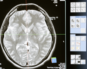 Tratamento agudo da enxaqueca em adultos: especial NeuroUSP