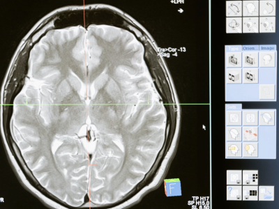 Tratamento agudo da enxaqueca em adultos: especial NeuroUSP