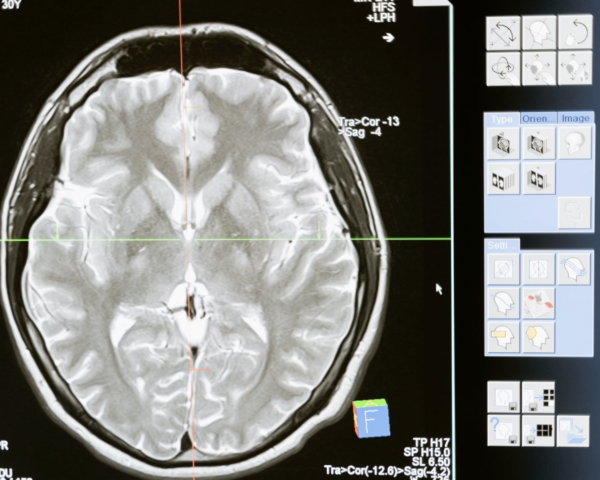 Tratamento agudo da enxaqueca em adultos: especial NeuroUSP