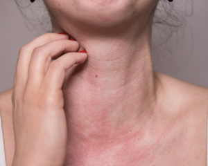 Anafilaxia: reconhecimento rápido e tratamento de emergência