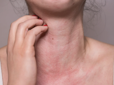 Anafilaxia: reconhecimento rápido e tratamento de emergência