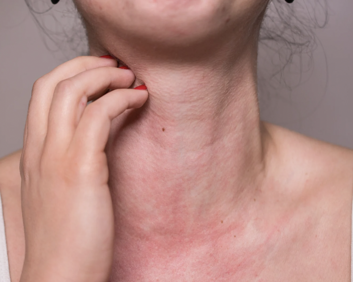 Anafilaxia: reconhecimento rápido e tratamento de emergência