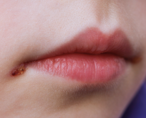 Herpes labial: diagnóstico, tratamento e prevenção na prática clínica