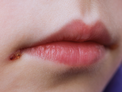 Herpes labial: diagnóstico, tratamento e prevenção na prática clínica