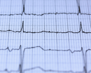 Novo episódio de fibrilação atrial: como reconhecer, avaliar e conduzir
