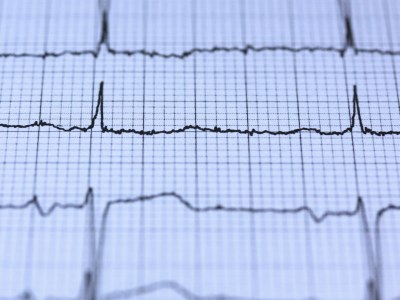 Novo episódio de fibrilação atrial: como reconhecer, avaliar e conduzir