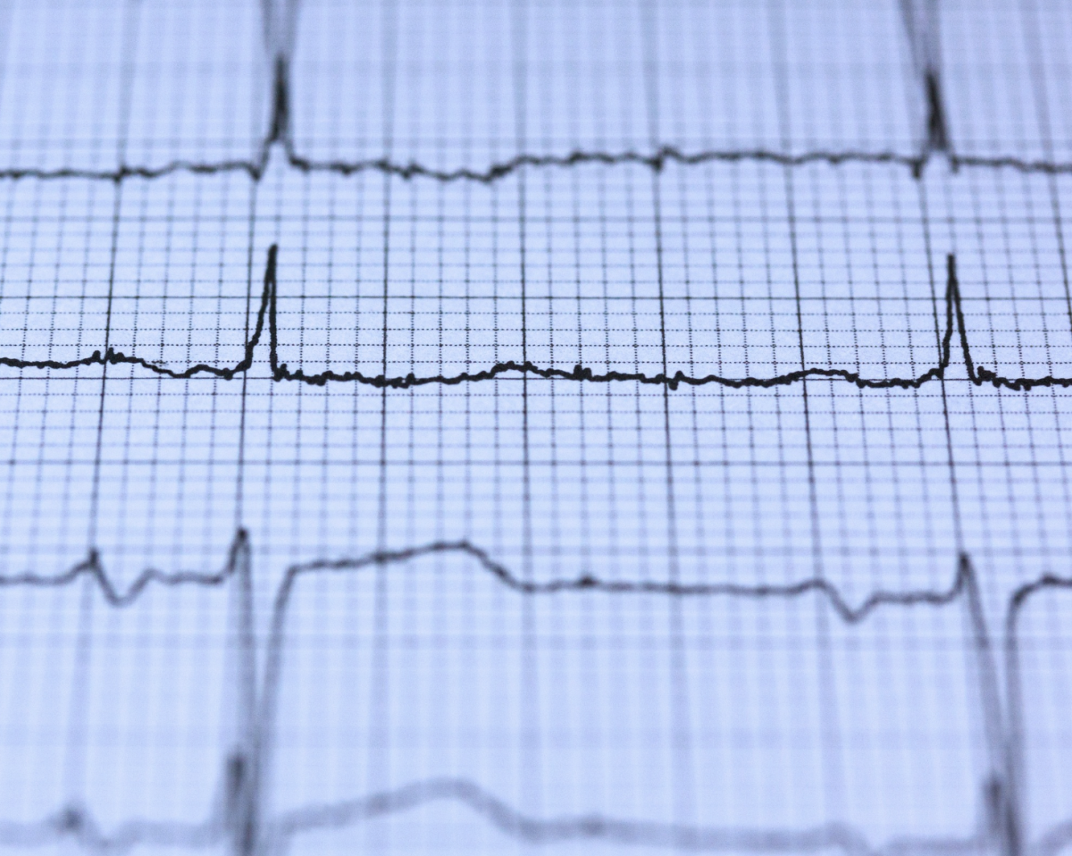 Novo episódio de fibrilação atrial: como reconhecer, avaliar e conduzir