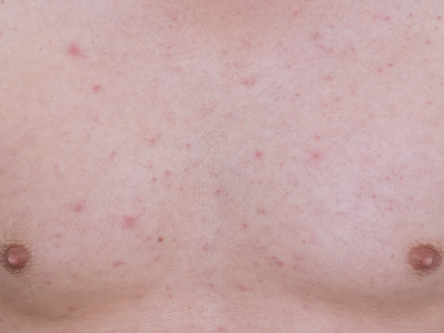 Avaliação de exantema maculopapular: causas, sinais de alerta e investigação