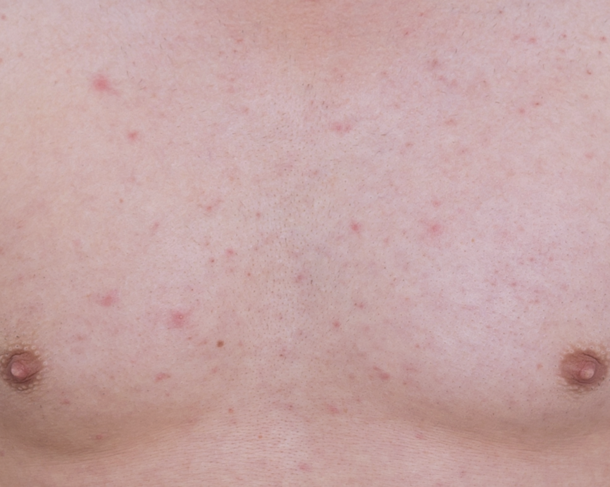 Avaliação de exantema maculopapular: causas, sinais de alerta e investigação