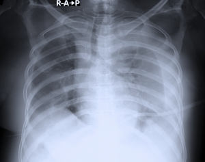 Derrame pleural: causas, diagnóstico e quando drenar