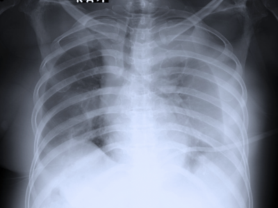 Derrame pleural: causas, diagnóstico e quando drenar