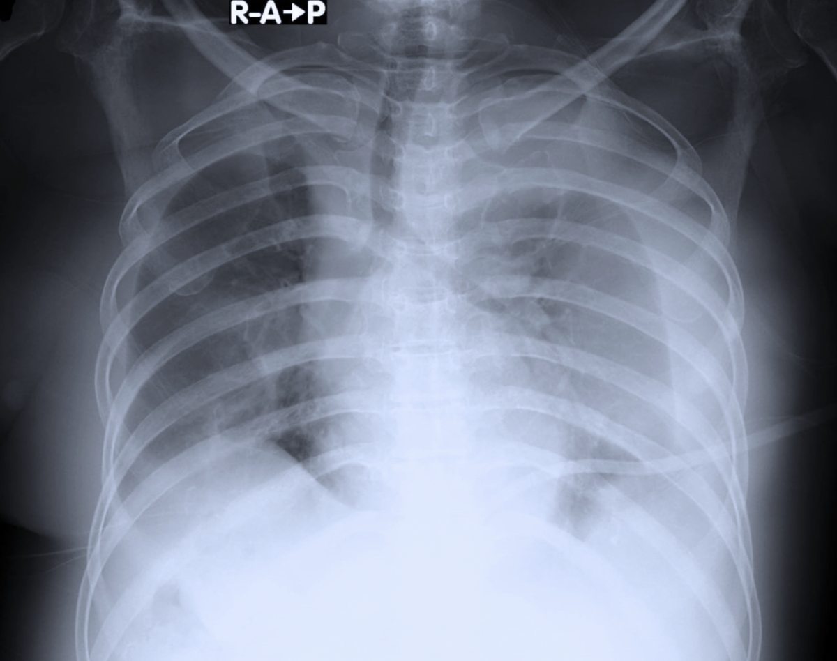 Derrame pleural: causas, diagnóstico e quando drenar